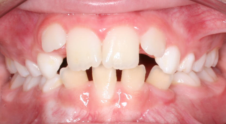Child's teeth before early orthodontic treatment, Cheron Orthodontics patient DA34