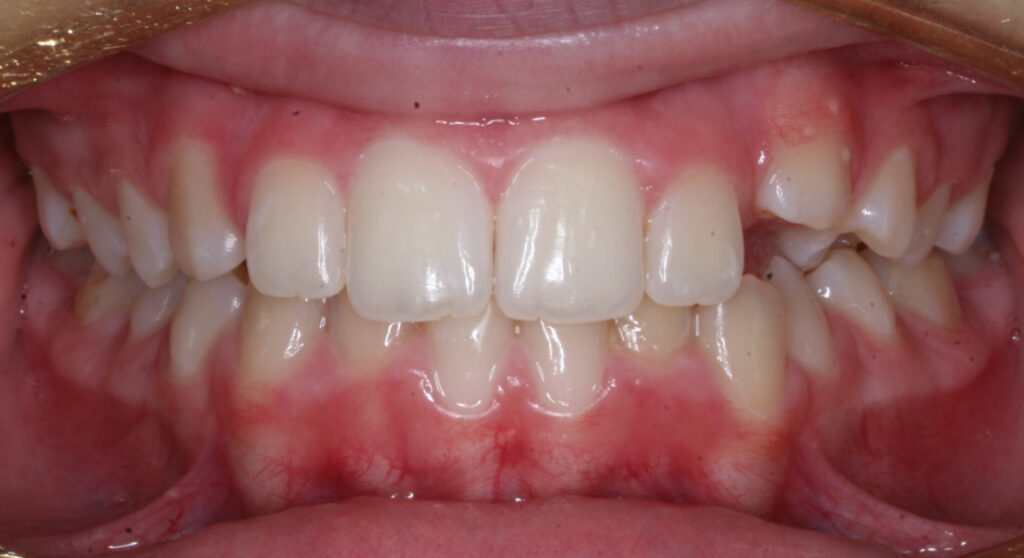 Teeth after phase 1 early orthodontic treatment, Cheron Orthodontics patient DA34