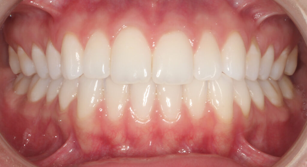 Teeth after phase 2 orthodontic treatment, Cheron Orthodontics patient DA34