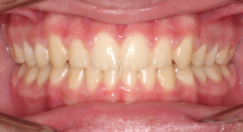 Teeth after orthodontic treatment, Cheron Orthodontics patient MC114