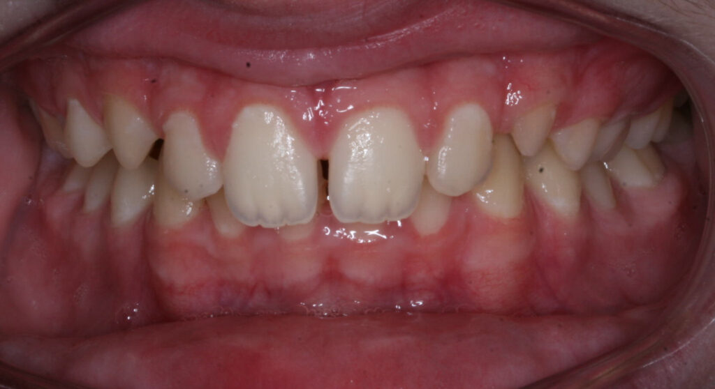 Teeth before orthodontic treatment, Cheron Orthodontics patient MC114