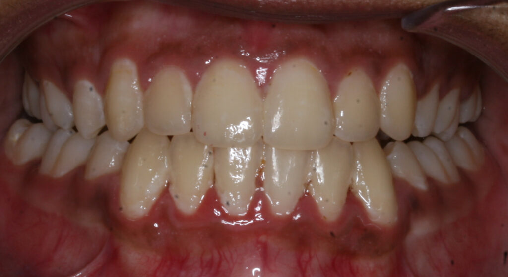 Teeth after orthodontic treatment, Cheron Orthodontics patient QA1