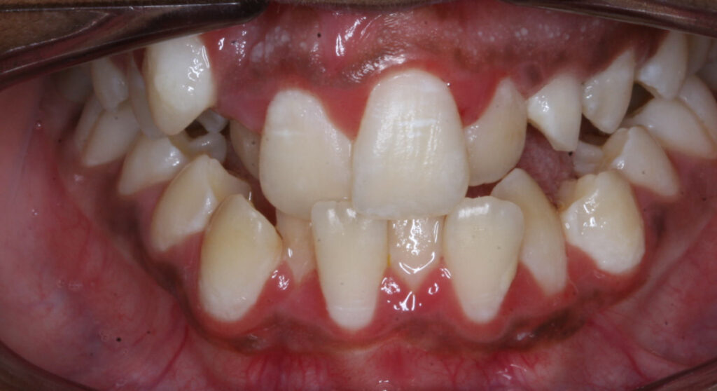 Teeth before orthodontic treatment, Cheron Orthodontics patient QA1