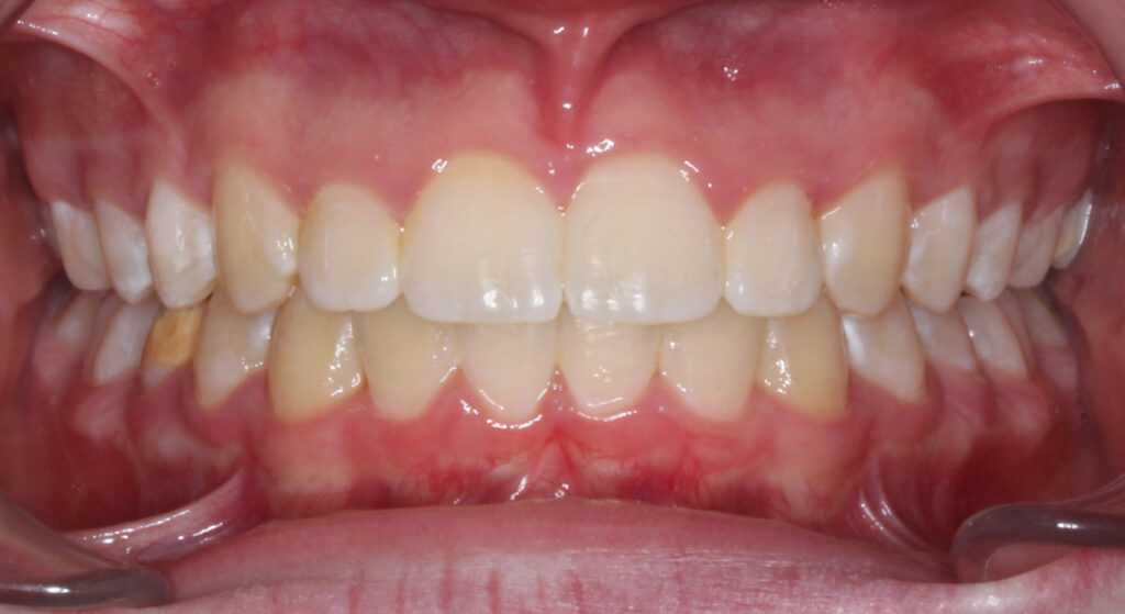 Teeth after orthodontic treatment, Cheron Orthodontics patient RO118
