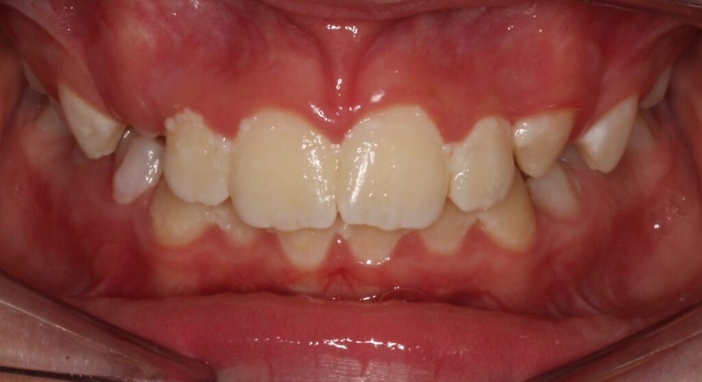 Teeth before orthodontic treatment, Cheron Orthodontics patient RO118