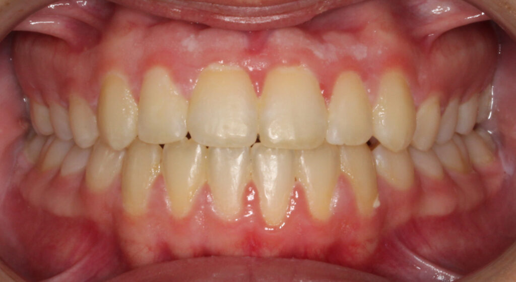 Teeth after orthodontic treatment, Cheron Orthodontics patient SE42
