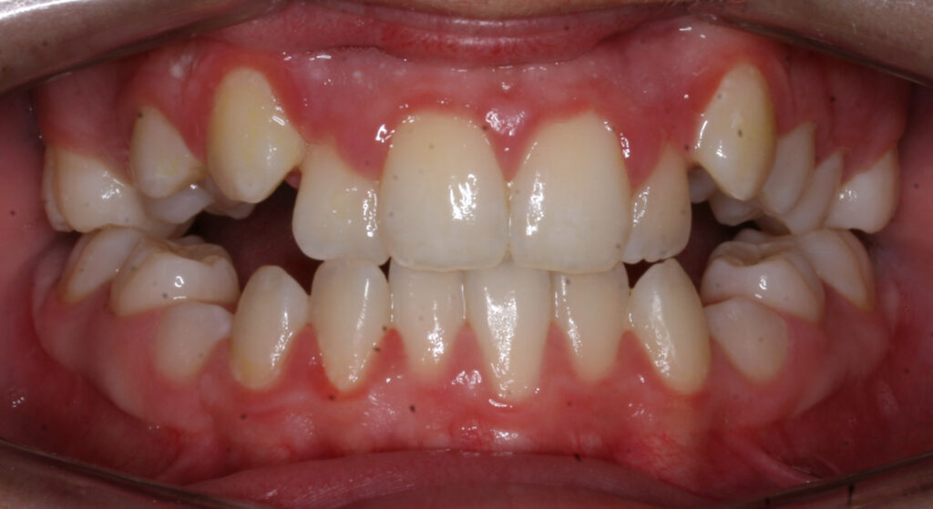 Teeth before orthodontic treatment, Cheron Orthodontics patient SE42