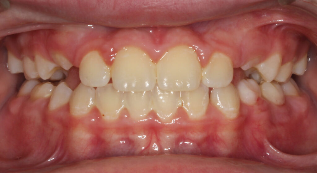 Teeth after phase 1 early orthodontic treatment, Cheron Orthodontics patient ZE12