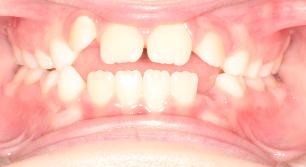 Child's teeth before phase 1 early orthodontic treatment, Cheron Orthodontics patient ZE12